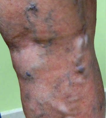 Venas varicosas en las piernas evaluadas por el Dr. Marvin Lazo